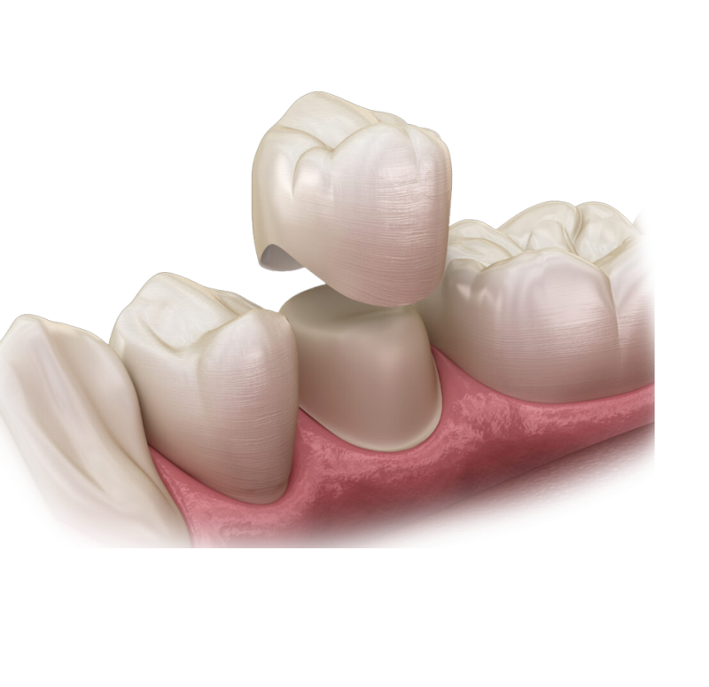 dental-crown