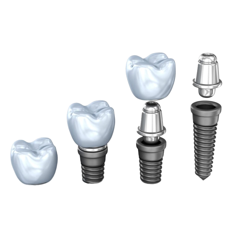 dental-implant